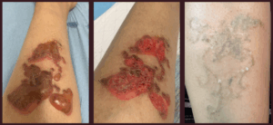 MorphIUs Laser & Longevity Studio Skin Journeys Tattoo Removal